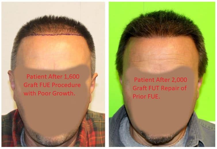 Most recommend FUT before FUE. This is the only way to maximize donor and ensure you do NOT run out of grafts. But can you undergo FUT after FUE? Will it work? fellermedical.com/can-i-have-an-…