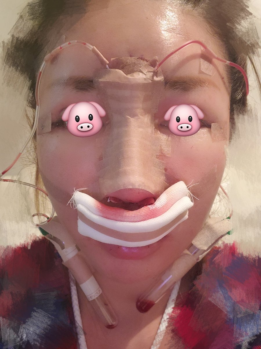 眉間プロテーゼ