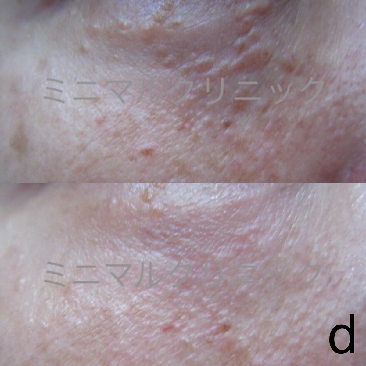 Twitter पर 汗管腫 かんかんしゅ エクリン汗嚢腫 稗粒腫 はいりゅうしゅ 目の下のブツブツ レーザー治療専門 １４d 専門的にレーザー治療しています 公式サイト T Co Y9coxhgk32 レーザー認定医 汗管腫 かんかんしゅ 稗粒腫 はいりゅうしゅ ひ