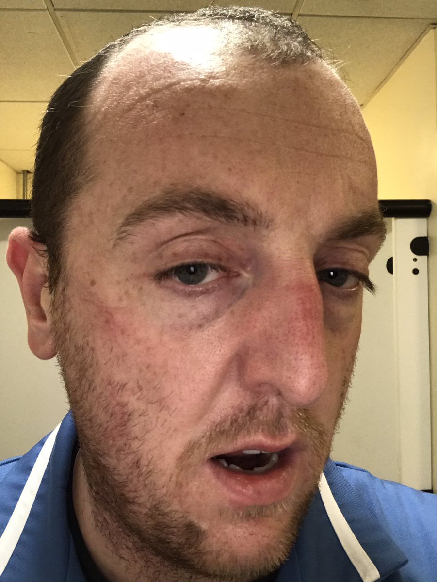 Kieranpmccormic's tweet photo. Before, during &amp; after pics of my first full night shift on the #frontline. #sore #scared #tired #sad #confused #proud #respect #inspired - I’m not ‘brave’, I’m not a ‘hero’. I’m a Nurse doing what i believe is right with the skills that I have for those in their hour of need 😞 https://t.co/D02q7jmiJE