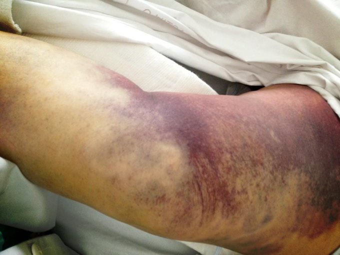 Quiero hacer mi primer estudio observacional vía Twitter acerca de las lesiones en el confinamiento. 
Por favor, ¡RT! 
Abro hilo (1/12)

I want to do my first observational study by Twitter about injuries during covid confinement. 
Please RT. 
Thread (1/12)