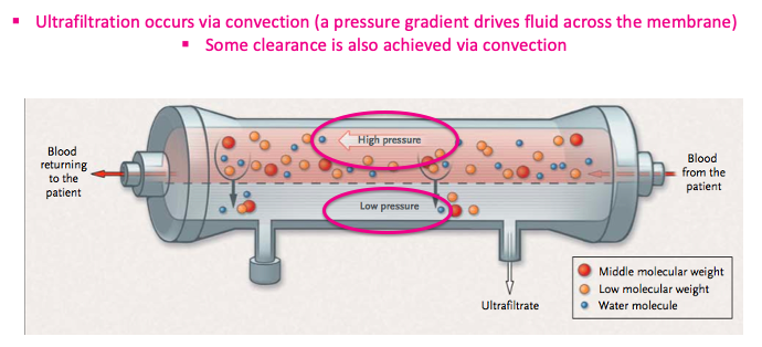 6/ So that's how we remove solute. What about the fluid? Ultrafiltration (UF), or ISOTONIC fluid removal, is achieved via pressure that is exerted across the membrane that drives fluid out. DOI: 10.1056/NEJMct1206045  @luck_urine