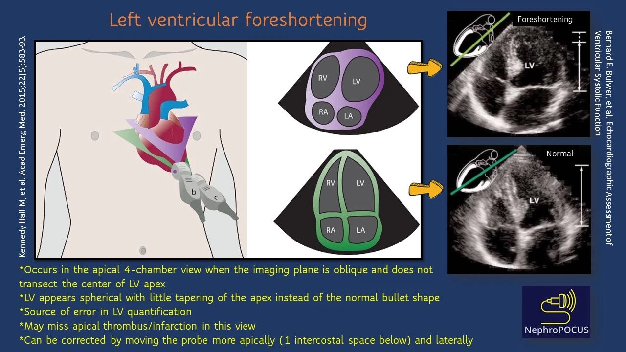 NephroPOCUS on X: This #POCUS finding can be missed on foreshortened  images. In addition to adjusting the imaging plane to transect the LV apex,  get other views to demonstrate the pathology (e.g.
