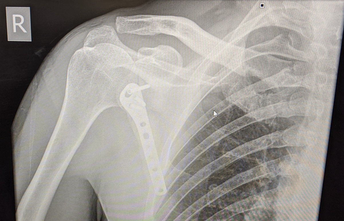 Bob Hart (@boberthart) on Twitter photo It was a nasty injury, so the orthopaedic team at Lancaster referred me to Wrightington Hospital. <a href="/wrightington16/">Wrightington Hospital</a>
At Wrightington <a href="/mrmikewalton/">Mike Walton</a> and team did a great job of putting the broken bits of me back together. Hereās what they did: It was a nasty injury, so the orthopaedic team at Lancaster referred me to Wrightington Hospital. <a href="/wrightington16/">Wrightington Hospital</a>
At Wrightington <a href="/mrmikewalton/">Mike Walton</a> and team did a great job of putting the broken bits of me back together. Hereās what they did: