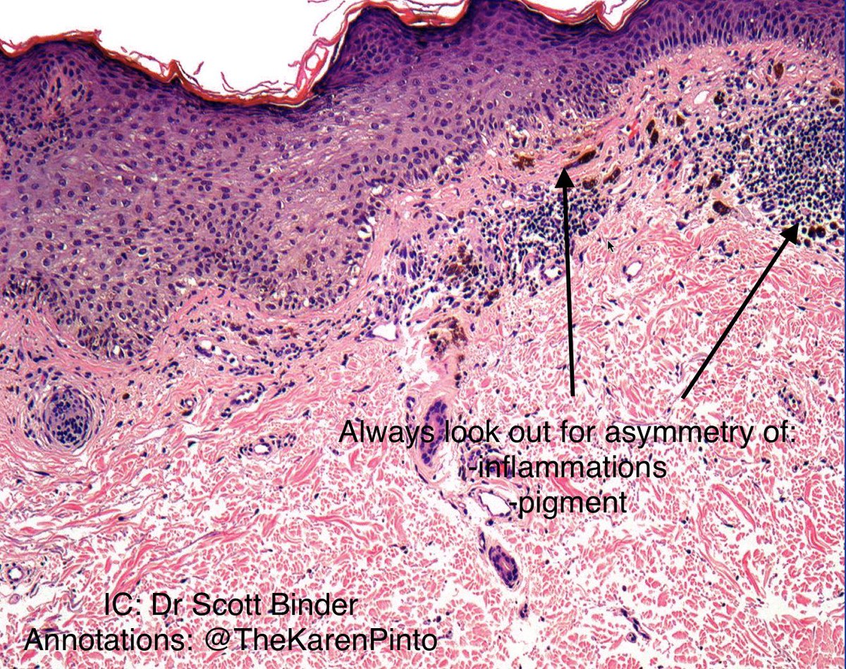 Points to remember from Dr. Scott Binder’s #CAPVirtualPath lecture 

#pathology #dermpath #melanoma

👉🏽if you see asymmetry (of inflammation or pigment) in your biopsy, you may want to ask for a better biopsy because asymmetry usually means something worse is probably present