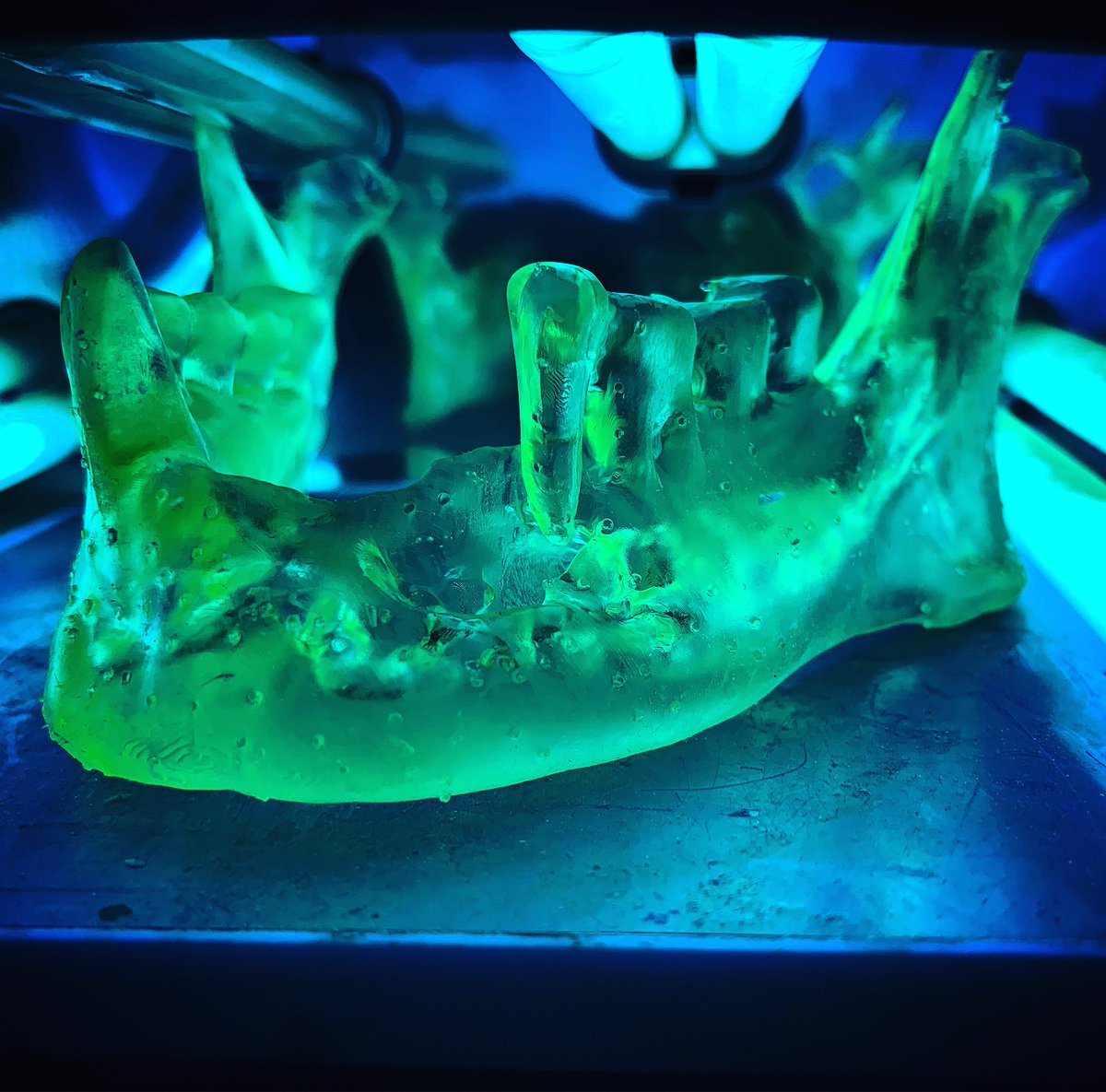 That is what I called beauty.#uvcuring 
Morning case 
3D printed mandible for mandible reconstruction (case courtesy: @drshaktideora , @apollocbcc )
#maxillofacialradiologi #3dprinted -#3dprintingindustry #3dprintingideas #maxillofacialsurgeon #oncosurgery @3dheals