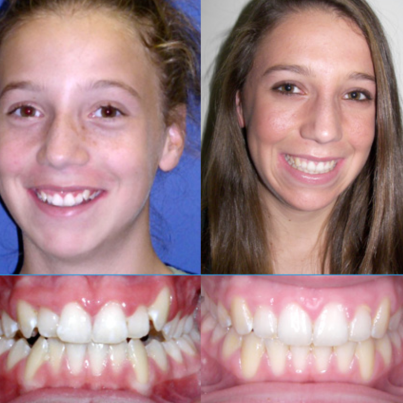 SternOrtho's tweet photo. Before and After treatment 😁.
.
#SternOrtho #orthodontics #invisalign #braces #teeth #smile #love #pretty #handsome #southjersey #jersey #dentist #cherryhill #whiteteeth #straighteeth #oralsurgery #ortho https://t.co/3vGL6WHvcj