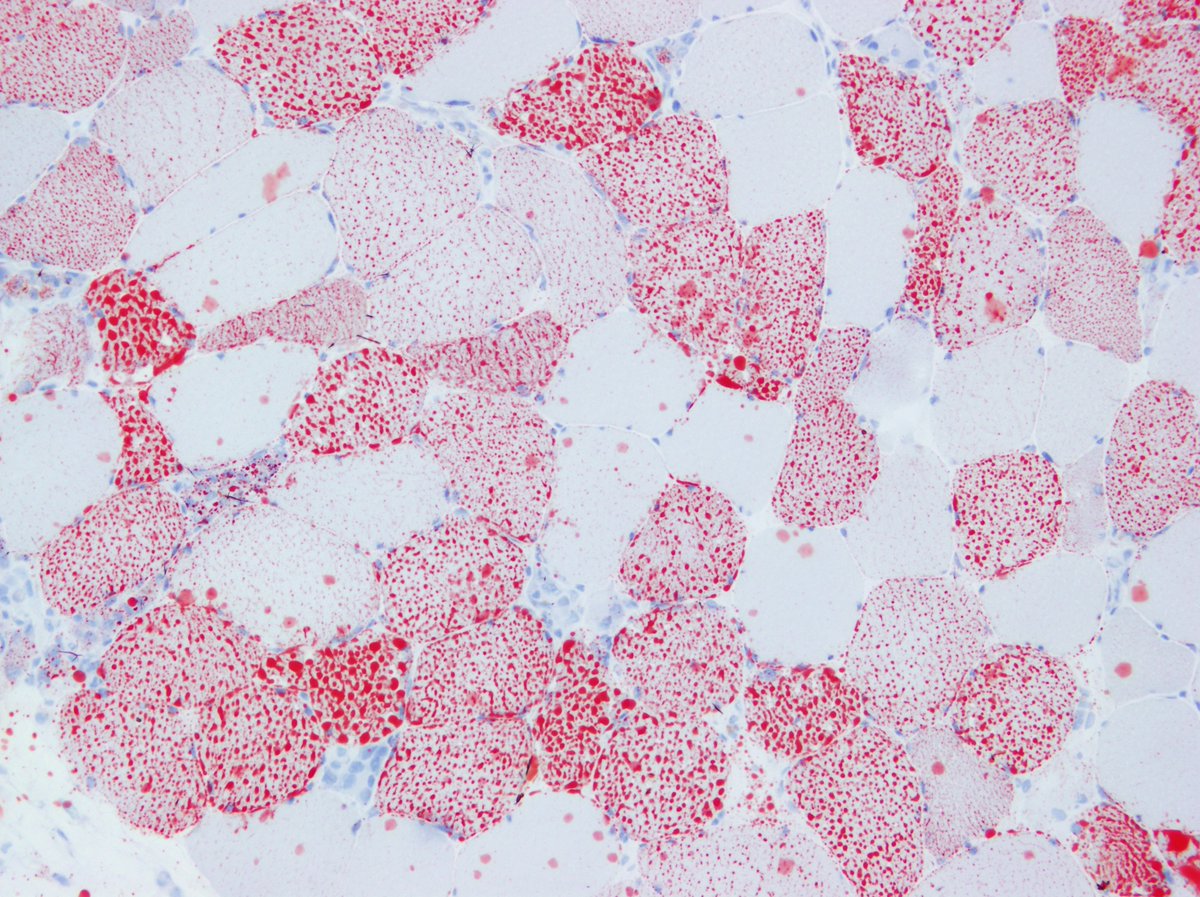KaarlePadilla's tweet photo. A 55-year-old woman consulted for lower extremity proximal muscle weakness, dysphonia and cervical weakness. HEE and Oil Red O. #neuropath #pathology https://t.co/HjvWbhMQi2