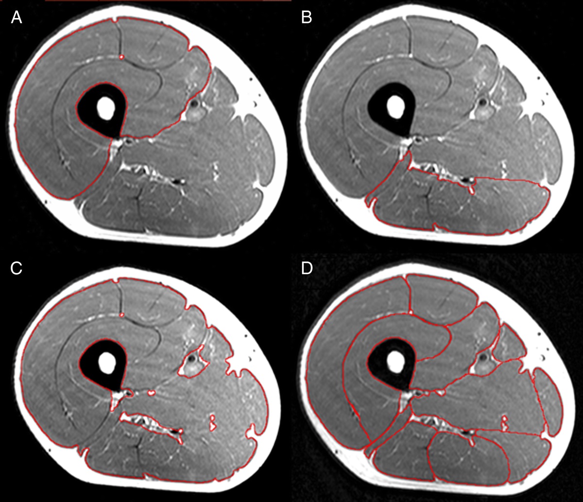 Thigh muscle disuse atrophy occurs rapidly and is already evident within 2 d of leg immobilization and progresses at a similar rate over the next 5 d (~0.8% muscle loss per day). M. quadriceps muscle shows more atrophy when compared with the M. hamstrings.journals.lww.com/acsm-msse/Full…