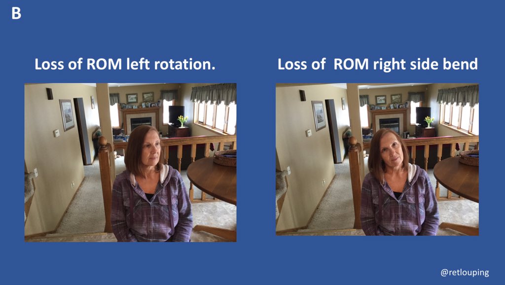 There are two patterns of movement loss that commonly occur in patients, one which seems obvious and one not so obvious. Lets discuss the less obvious and sometimes confusing pattern of loss. Below is loss of left rotation and right side bending.