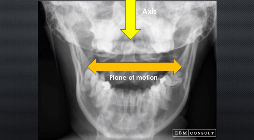 If the patient presents with loss of side bending to the right and loss of functional rotation to the left, I will propose this is a restriction of the head joints, not the neck complex below C2.Remember the mouth is the plane and nose is the axis of motion