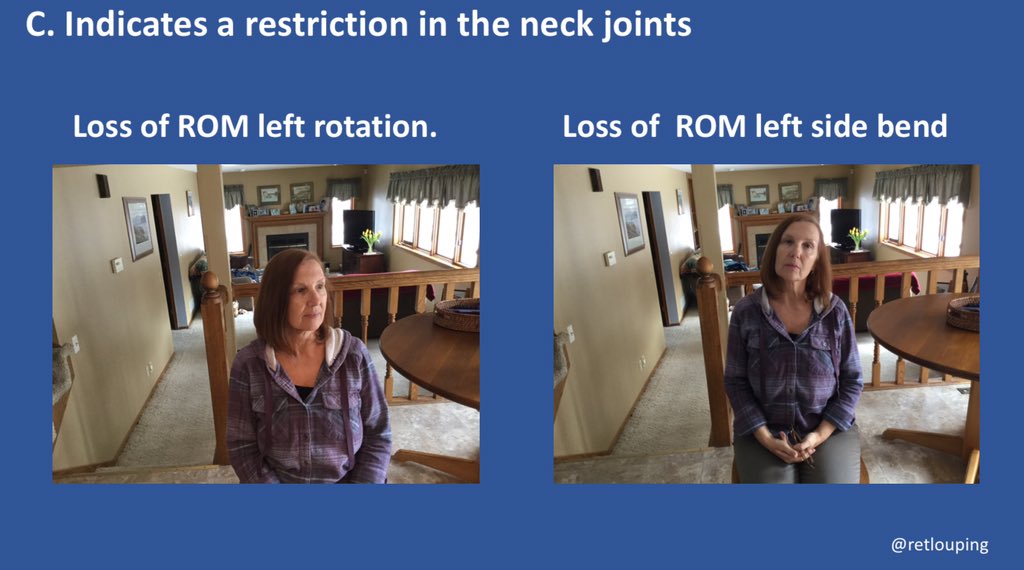 The second common motion loss is loss of functional rotation and side bending to the same side (see below) using the same principles one can propose that this is due to restriction in the joints of the neck not the head as having full right rotation means the AA joint moves...