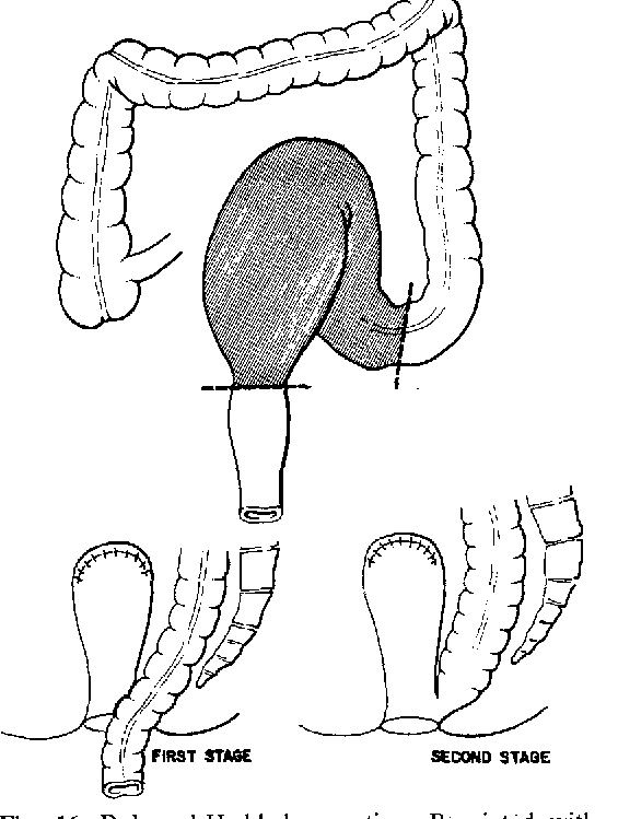 El megacolon chagásico también es relevante para los #Cirujanos. Uno de sus tratamientos: la #Cirugía de Duhamel-Haddad, donde se cerraba el muñón rectal, y se exteriorizaba el colon proximal por el periné, para después conectarlo lateralmente 😮😮😮 #WorldChagasDiseaseDay