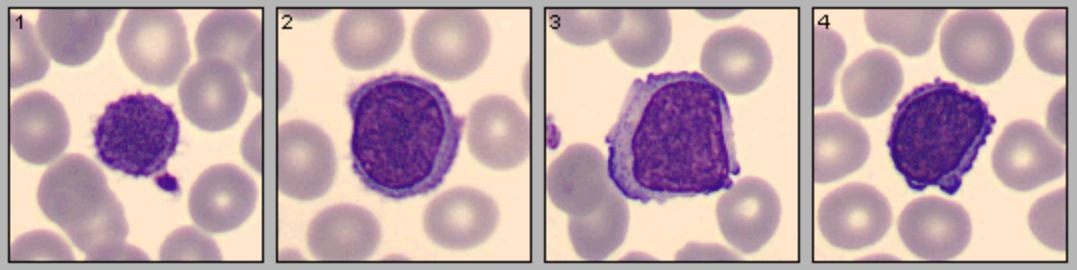 DavidCrzG's tweet photo. Which of these cells is misclassified?
#peripheralbloodsmear
#cytology
#cellsconfination
#cellavision
#englishversion https://t.co/Y3AFIkve15