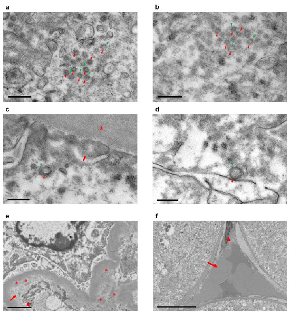 NephJC's tweet image. Virions were characterized by being 65-136 nm, with 20-25 nm spikes, and having a solar corona configuration.  Pictures are shown below: #NephJC