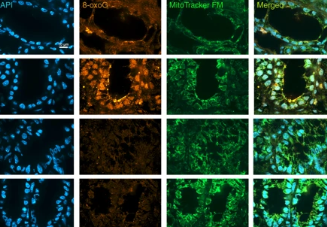 Intestinal_Cell's tweet photo. Latest from the @MartinLabUofT: Study suggests that #IBD patients might benefit from the use of antioxidants or inhibitors of iNOS to blunt the oxidative DNA damage that can precipitate #colitis-associated #ColonCancer.  https://t.co/sCIVqMxmgK https://t.co/1qKdyhuhbh