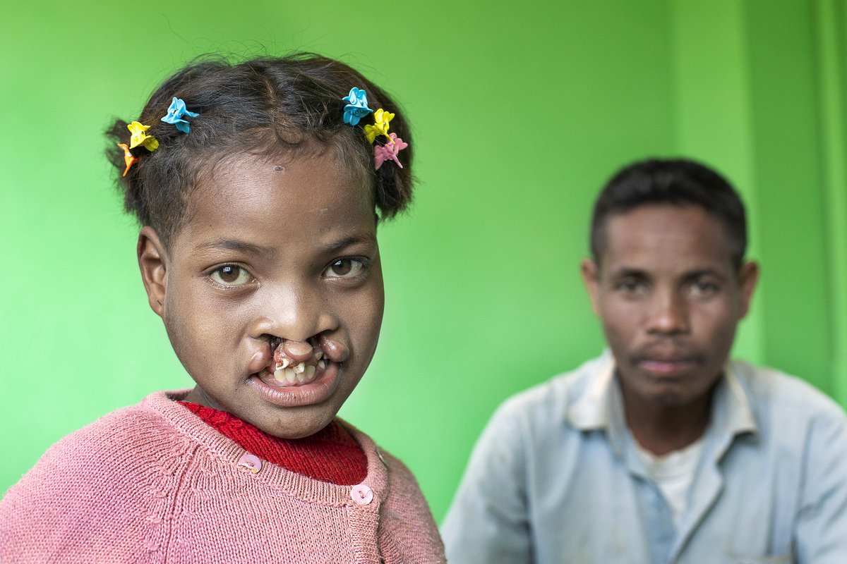 OpSmileSA's tweet photo. Clara was raised by her father Dede. He was heartbroken to see his child suffering. People in their village spoke of Operation Smile. Clara had a chance to regain confidence, go to school, participate and socialise.
Become a #SmilePartner and help children like Clara. https://t.co/jXzGMMxHkd