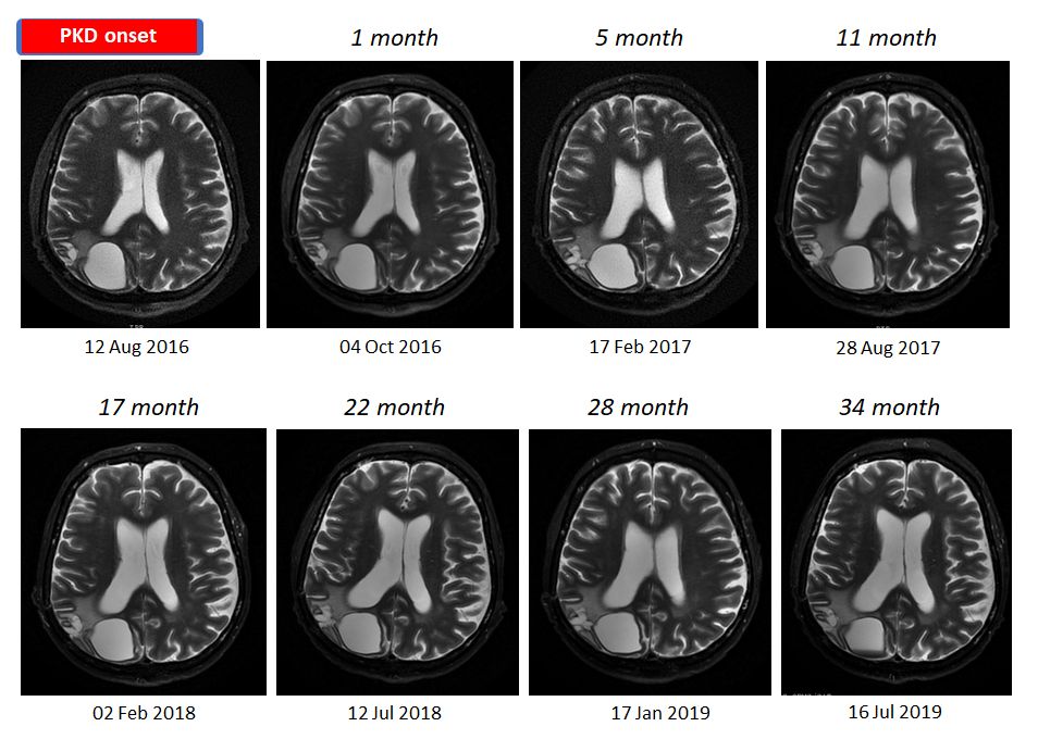 Center For Nutrition And OncoMetabolism (@oncometabolic) on Twitter photo Congratulations to Dr. Zsofia Clemens & PaleoMedicina team on 38-month progression-free & symptom-free survival of patient with recurrent GBM using Paleolithic Ketogenic Diet (PKD) as a stand-alone treatment.
paleomedicina.com/hu/glioblastom… Congratulations to Dr. Zsofia Clemens & PaleoMedicina team on 38-month progression-free & symptom-free survival of patient with recurrent GBM using Paleolithic Ketogenic Diet (PKD) as a stand-alone treatment.
paleomedicina.com/hu/glioblastom…