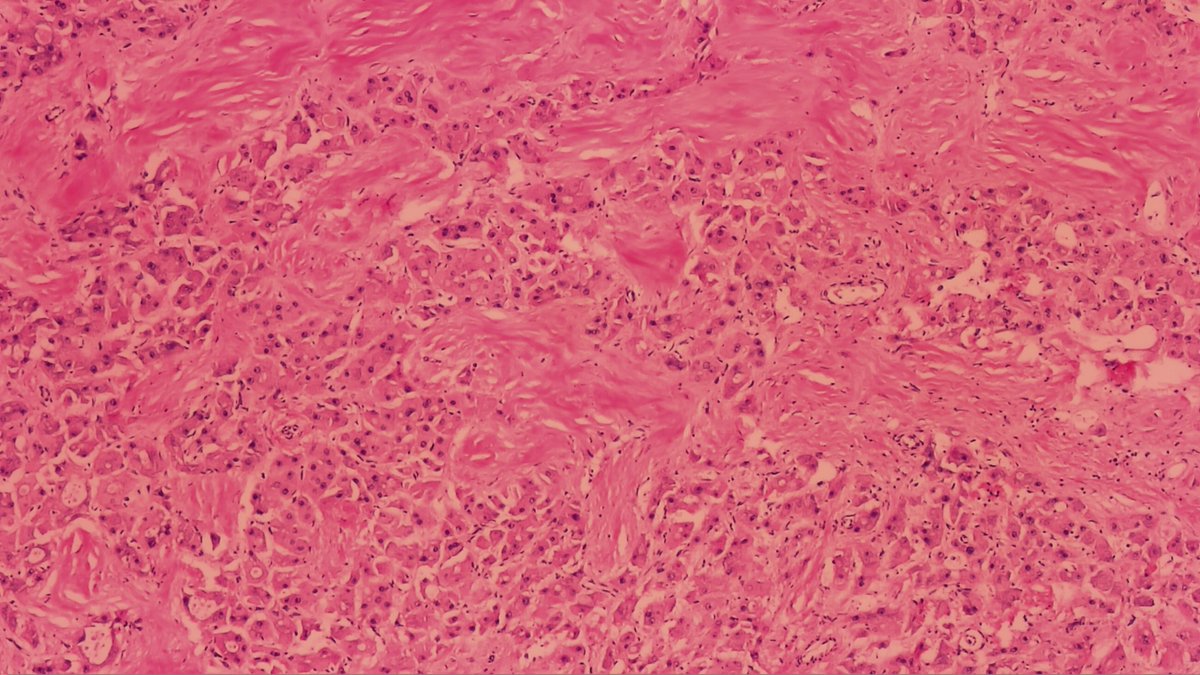 MoticPathEU's tweet image. 18-years-old woman with an expansive liver mass 8cm length. 
☑️Lobectomy specimen.
⬜️What&apos;s your diagnosis?

📸Dr. Diaz with #Moticam X3
#MoticEurope #Motic #DigitalPathology #Pathology #Oncology