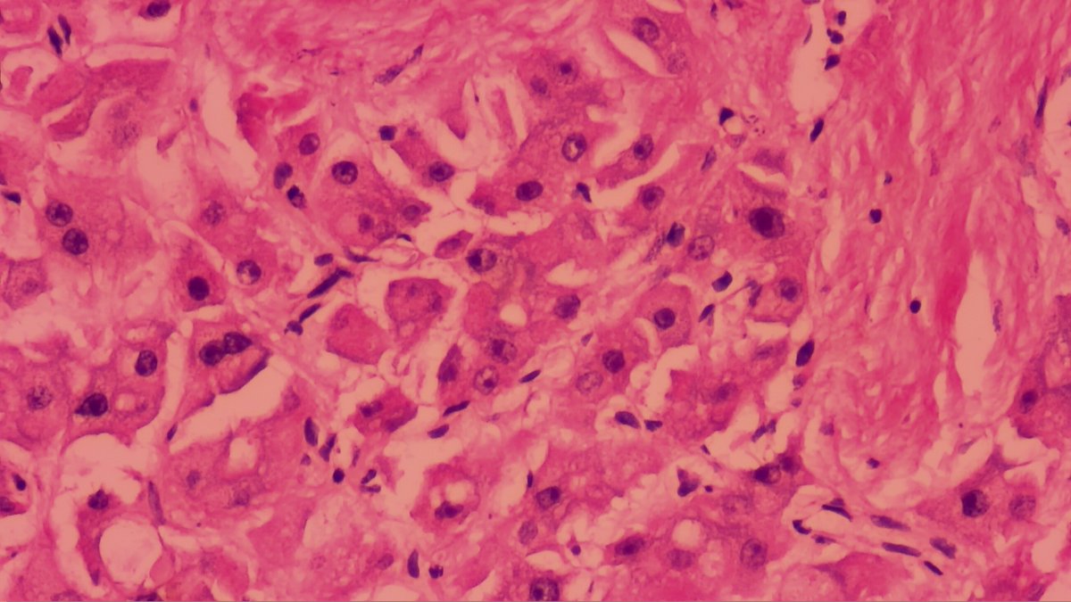 MoticPathEU's tweet image. 18-years-old woman with an expansive liver mass 8cm length. 
☑️Lobectomy specimen.
⬜️What&apos;s your diagnosis?

📸Dr. Diaz with #Moticam X3
#MoticEurope #Motic #DigitalPathology #Pathology #Oncology