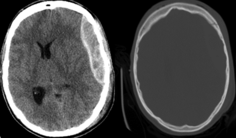 13) The results from the head CT are shown below. What do you see?  #BBEDH