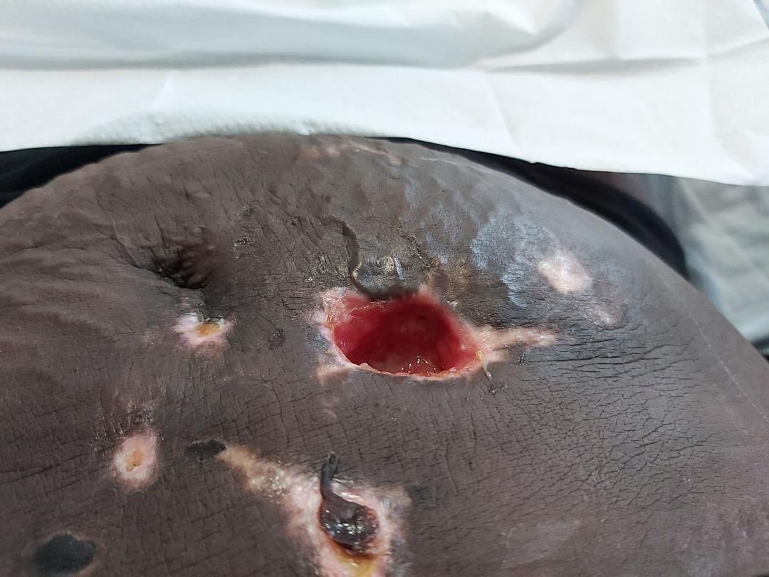 These are pictures of another patient who encountered misfortune in the hands of Dr Anu and the MedContur clinic. This was just February 2020.The lady in this pic just got back from Uk and decided to do surgery at her clinic.Now she’s battling for her life.Cc  @TundeIrukera