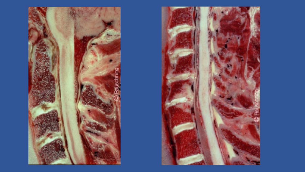 These clefts continue to develop and the boney changes continue until around age 21 when the posterior disc of the lower neck may be fissured completely in th eposterior aspect and through 50% of the disc postero-anteriorly (see Mercer and Bogduk)