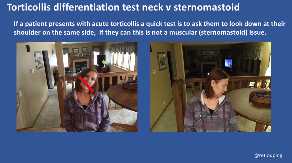 This was described in the paper above link here  https://sofmmoo.org/documents/torticolis_spine.pdfTo differentiate between torticollis from sternomastoid spasm and the neck joints we can utilize our previous knowledge of head joints, neck joints and muscle action. Sternomastoid spasm would lock the head