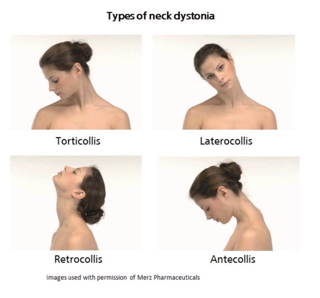 There is a nice review here  https://www.ncbi.nlm.nih.gov/books/NBK539857/#_article-30277_s1_Torticollis in adults is not commo but often occurs as part of a neurological disorder dystonia and is often a muscular toxicity issue and often tremulous see here  https://www.dystonia.org.uk/neck-dystonia 