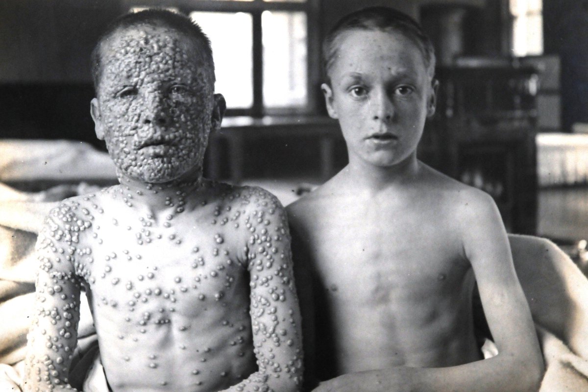 (1/11) SAVE  @drjennershouse, which is under threat due to the  #COVID19 pandemic! Edward Jenner was an 18thC pioneer of vaccination. Let me tell you about his importance in medical history[Photo of two children - one vaccinated against smallpox, the other not from museum].