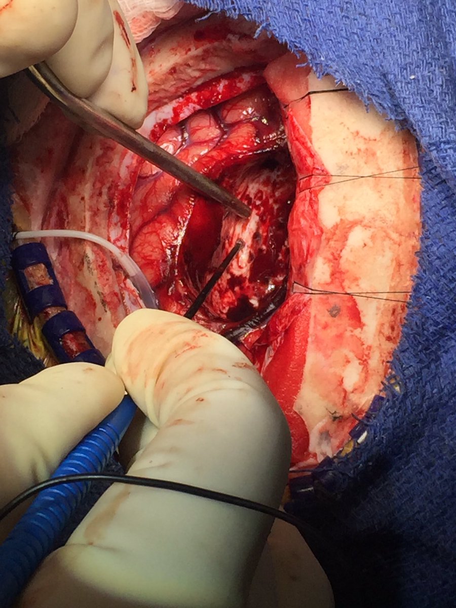 balzjr's tweet image. Beautiful tumor resection today using SSEP, phase reversal, TcMEP, DCS and deep white matter tract stimulation #iom #upmc #procirca