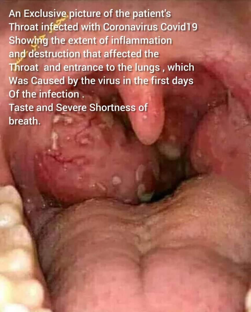 You can see what the virus can do. The extent of the inflammation in the throat in the first few days.We are dealing with a plague ravaging the whole world and we all need to take responsibility towards ending this pandemic. I don't want to die now. Do you? Please RT #StaySafe