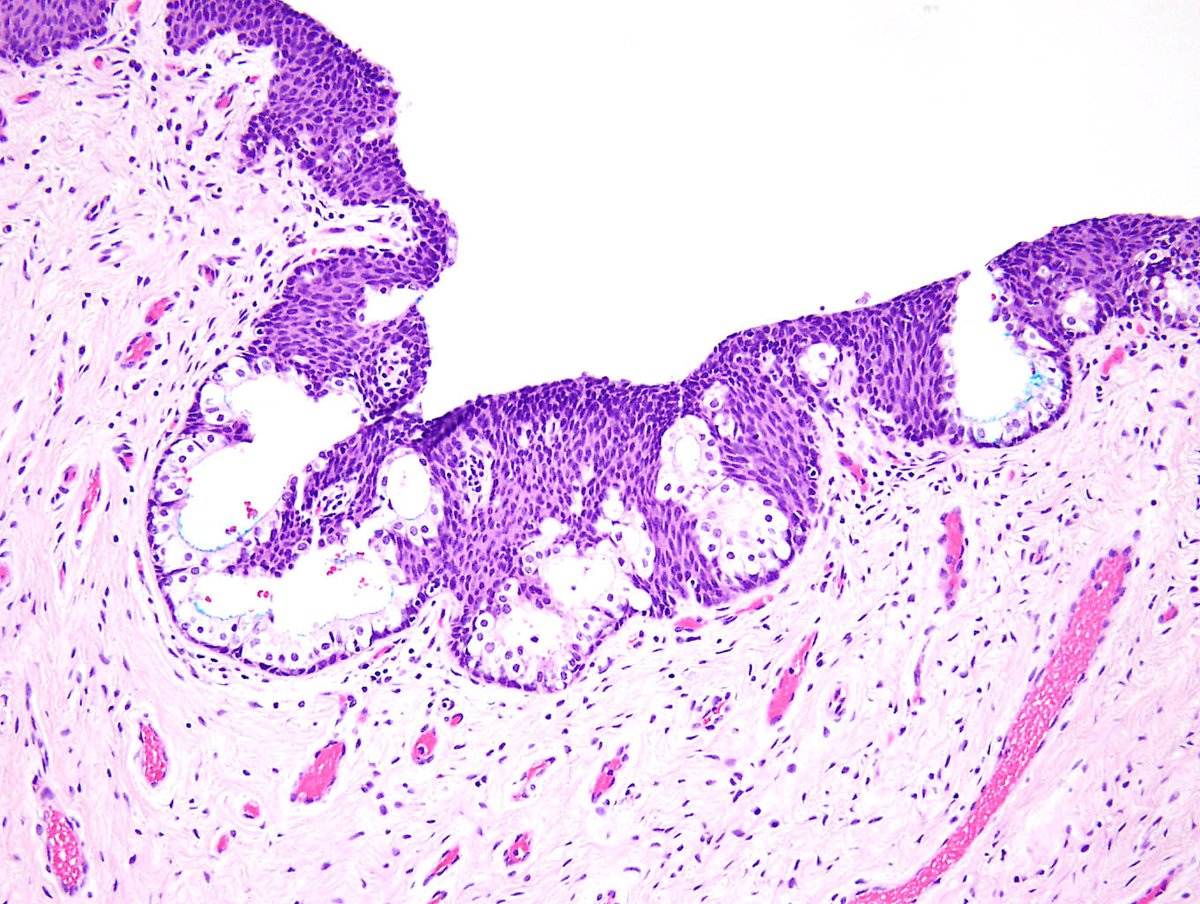 sovargasmd's tweet image. Why would vaginas resected in #genderaffirmingsurgery be carpeted by prostate? New paper showing #GYNPath in @AJSPjournal. Similar changes in hormone-treated #transgender patients and in #PediPath patients with endogenous androgen excess support a common cause!