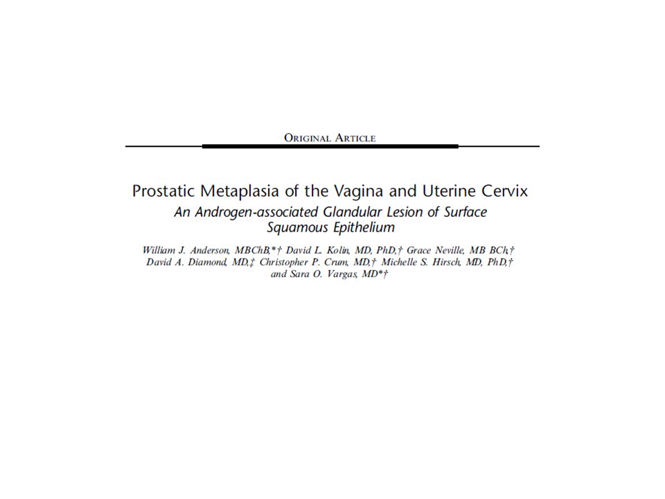 sovargasmd's tweet image. Why would vaginas resected in #genderaffirmingsurgery be carpeted by prostate? New paper showing #GYNPath in @AJSPjournal. Similar changes in hormone-treated #transgender patients and in #PediPath patients with endogenous androgen excess support a common cause!