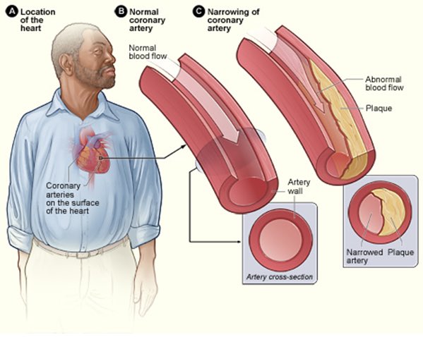 PeptideScience's tweet photo. Humanin peptide preserves blood vessel function and prevents atherosclerotic plaque progression [fat buildup] in mice with high cholesterol:
https://t.co/tae6fHS7br

#Humanin #Peptides #Atherosclerosis #HeartDisease #Plaque #Antioxidant #Apoptosis #Insulin
https://t.co/CqCLyZs6xG https://t.co/LeATI29ZNL