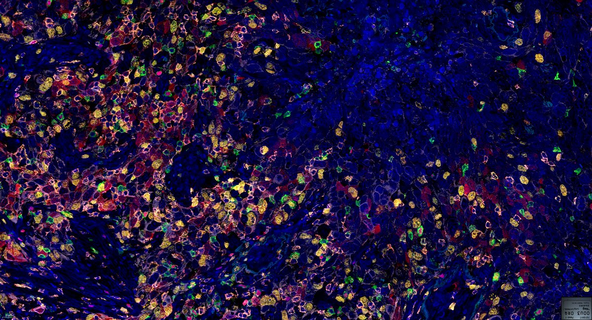 3DHISTECH_LTD's tweet image. Yet another  slide, brought to you by the PANNORAMIC Confocal digital slide scanner by 3DHISTECH.

#3dhistech #digitalpathology #pannoramicscanners #confocal