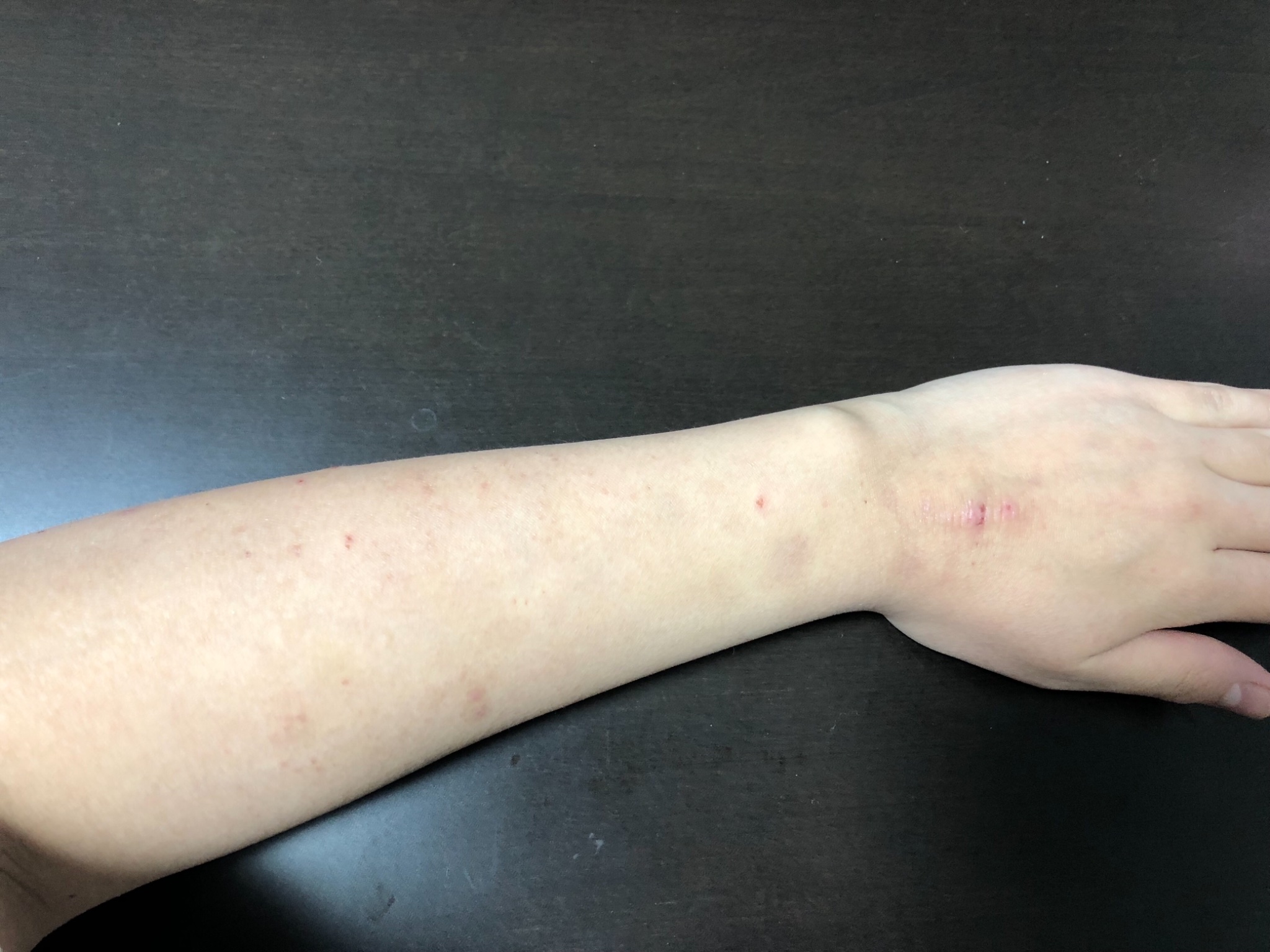えっちゃん 先日の 自傷行為 夫と喧嘩して行き場のない怒りを左腕にぶつけた 手だと手加減しちゃうからﾌｫｰｸで刺した 自傷行為 止められない 境界性パーソナリティ障害 痣 落ち着く 行き場のない怒り 本当はやめたい 自分で自分を噛む 自分で