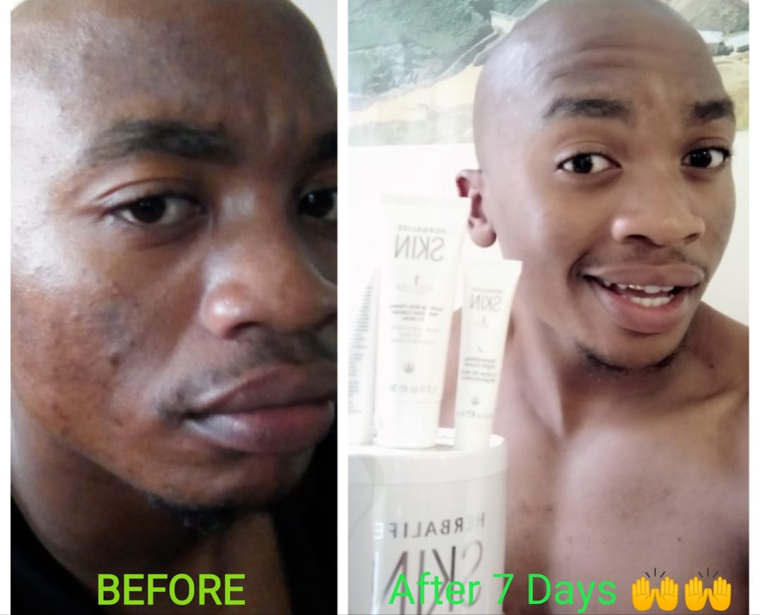 herbalife for acne