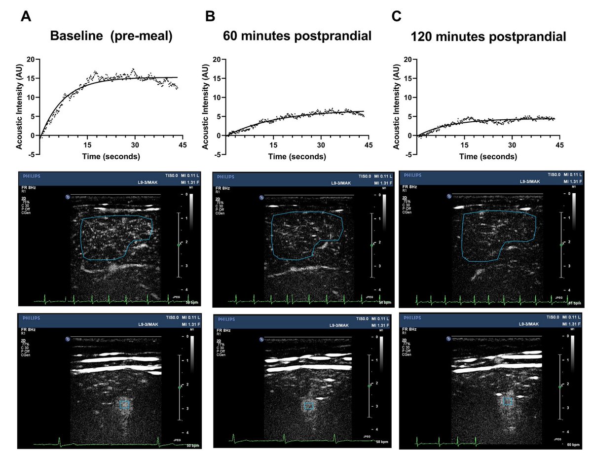 Despite increased femoral artery blood flow, muscle microvascular blood flow is substantially impaired for up to 2 hrs following high-glucose mixed nutrition meal ingestion in healthy adults! Our latest work @DeakinIPAN @deakinresearch journals.physiology.org/doi/abs/10.115…