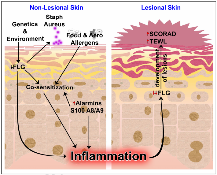 JACIInPractice's tweet photo. In Press! Events in #Normal #Skin Promote Early-life #Atopic #Dermatitis - the #MPAACH Cohort https://t.co/t0BELBi8HT https://t.co/ryYssZ6RP1