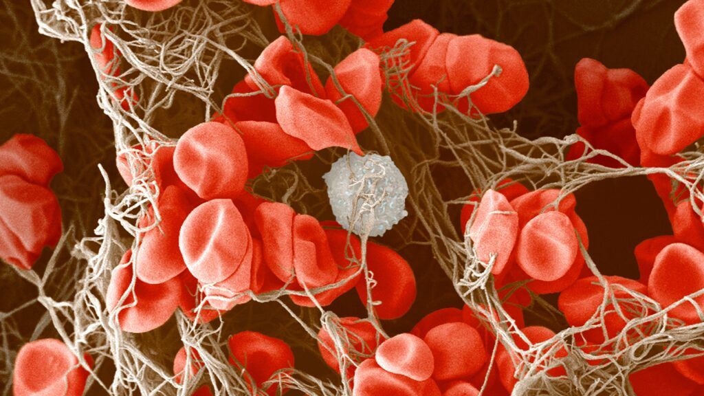 GxPeople's tweet photo. Blood clots in severe Covid-19 patients leave clinicians with clues about the illness — but no proven treatments

Read more via https://t.co/tnSlHWWO9u https://t.co/lHOPjZ7nVV