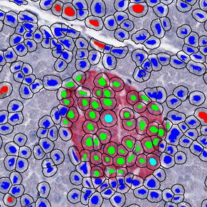 Mikroscan's tweet image. See Everything You Want on the Glass Slide from anywhere in the world, using live video streaming and a remotely controlled microscope. The L5 real-time telemicroscopy system from Mikroscan.

#pathology #digitalpathology #Covid_19 #coronavirus #WorkFromHome #SocialDistance