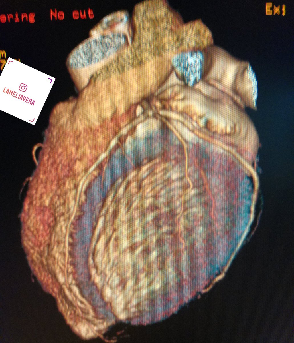 lameliav's tweet photo. Angiotomografia coronaria #angiocoronaria #angiotc #coronaria #cardiotc @lameliav ❤🥰🤓😀 https://t.co/CCCXgV3Nrl