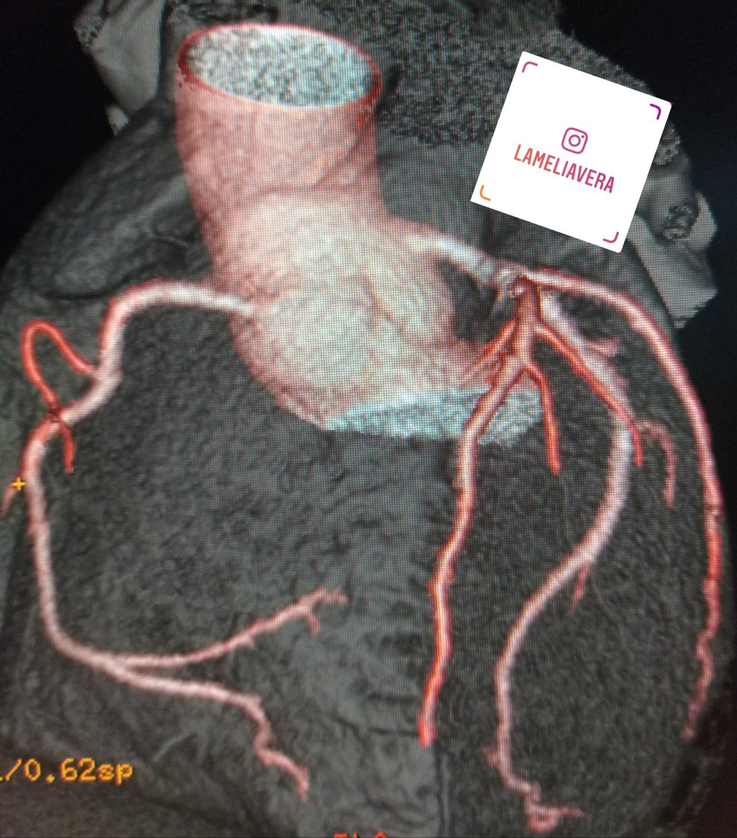 lameliav's tweet photo. Angiotomografia coronaria #angiocoronaria #angiotc #coronaria #cardiotc @lameliav ❤🥰🤓😀 https://t.co/CCCXgV3Nrl