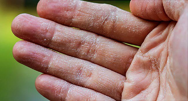 Lastly, images of each type of eczema. From left to right in the order I previously discussed them! • Atopic dermatitis • Contact dermatitis • Hand Eczema • Stasis dermatitis (Cont.)