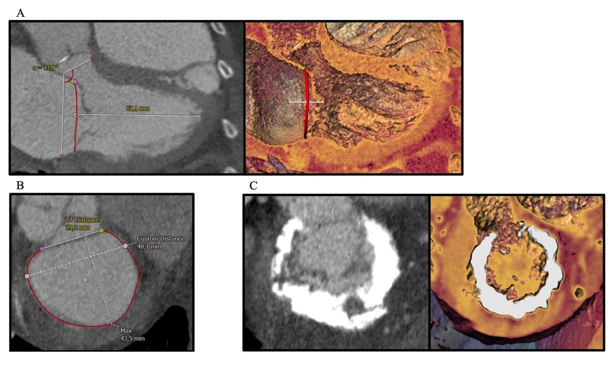 "Screening for Transcatheter Mitral Valve Replacement: A Decision Tree Algorithm" by @SebLudwig1 et al. #EAPCI bit.ly/3c9Nqb0