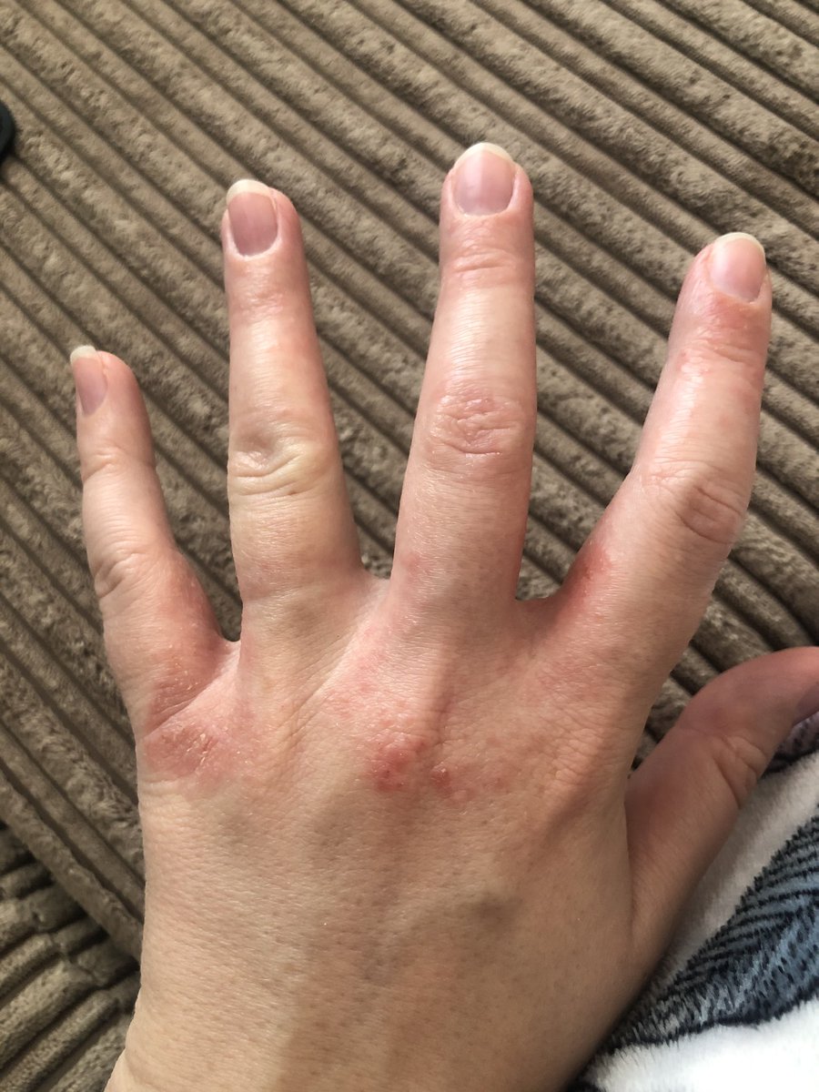 LauraBetts's tweet photo. PPE Problems. I’ve got gloves, but got no skin left 👍🏼 #nhs #PPE #🚑 https://t.co/stNuo1PHAq