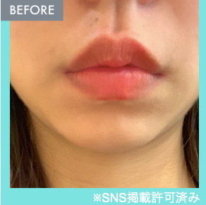 唇ヒアルロン酸注入