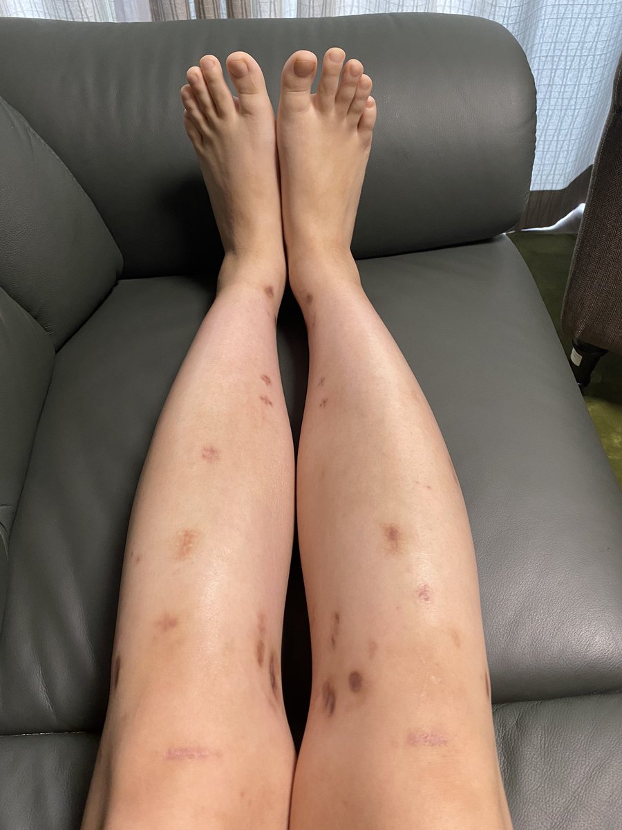 脚 延長 手術 失敗