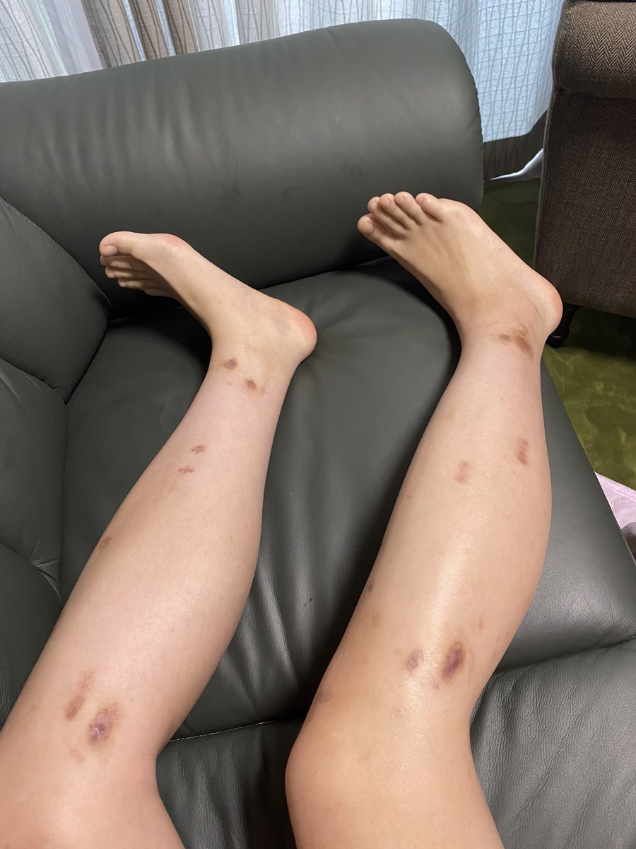 脚 延長 手術 失敗